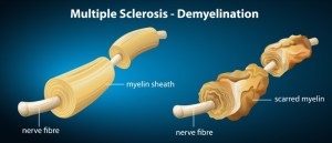 multiple-sclerosis-neurological-disorder-2